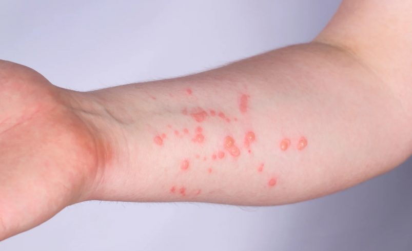 Suecia confirma el primer caso de viruela del mono fuera de África