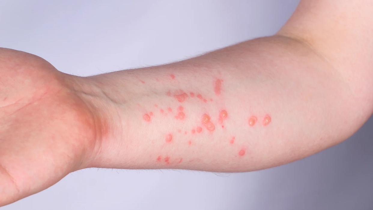 Suecia confirma el primer caso de viruela del mono fuera de África